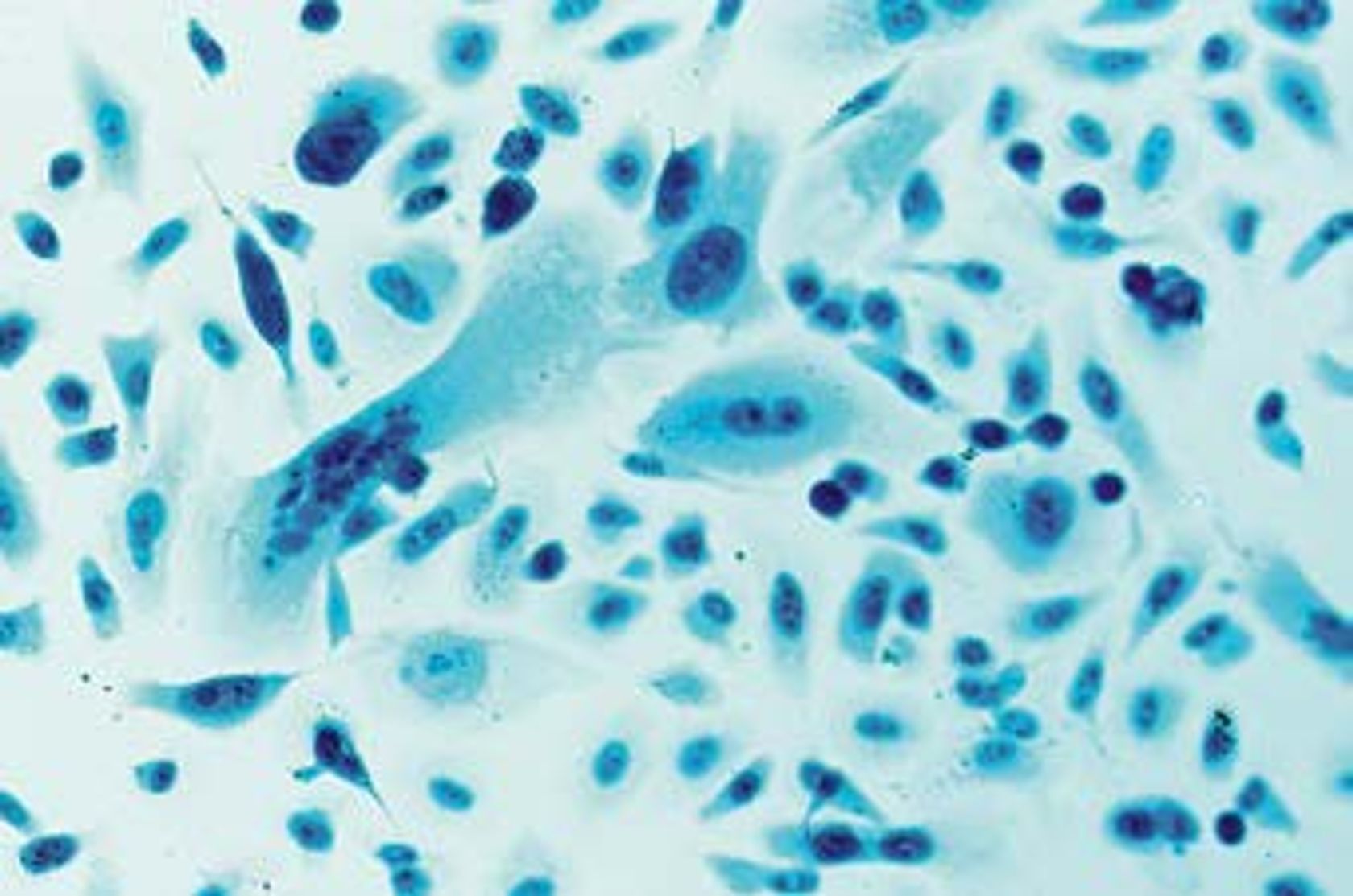 Histologie eines PCa: Prostatakarzinom-Zellen unter dem Mikroskop.