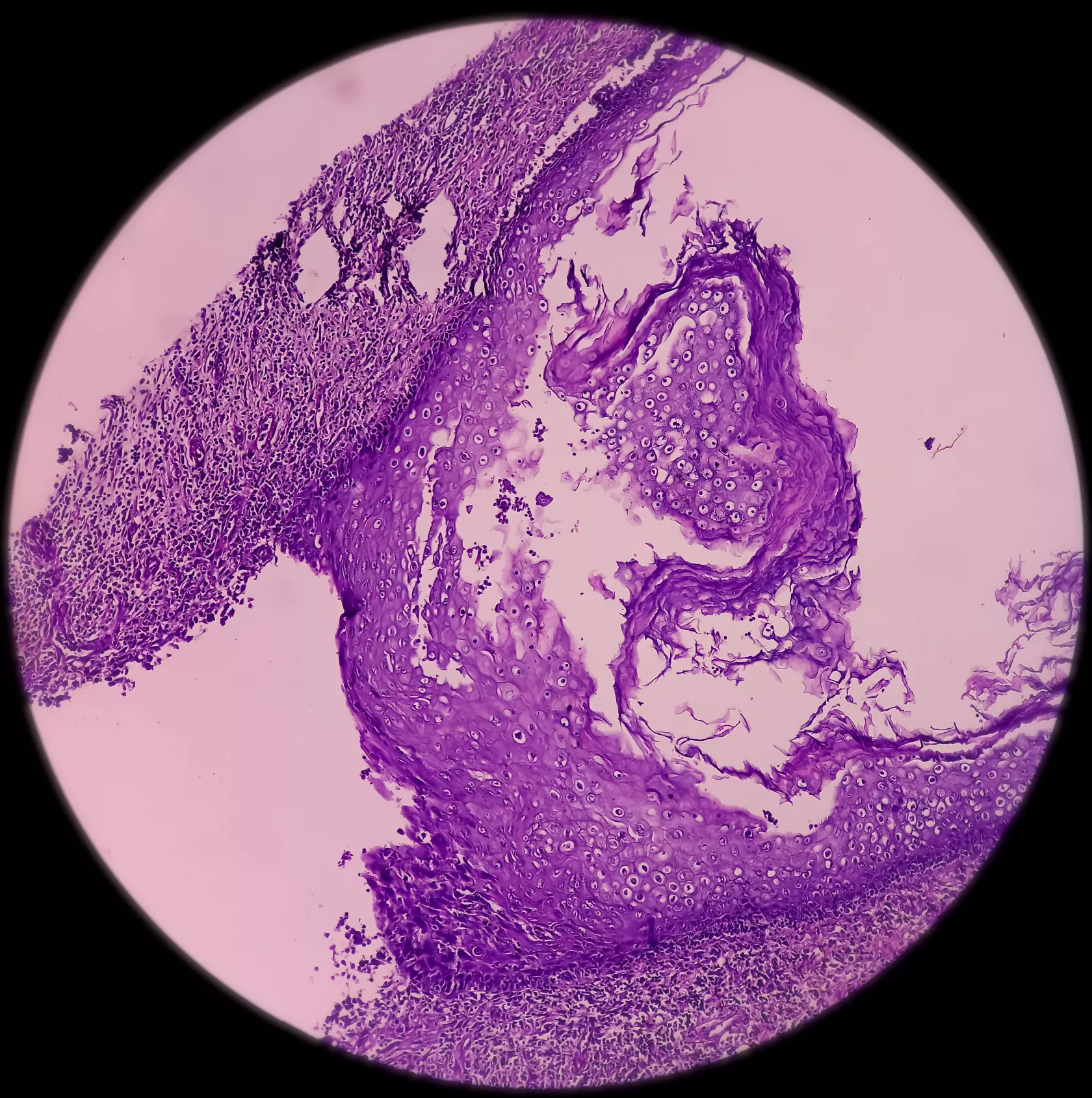 Mikroskopische Aufnahme einer Krebsmasse am Hals, metastasierendes Adenokarzinom