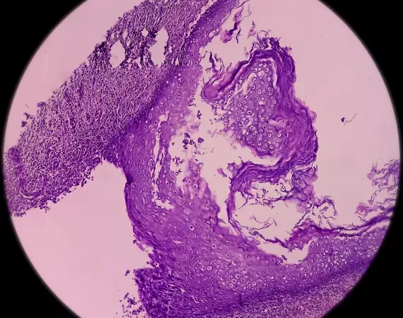 Mikroskopische Aufnahme einer Krebsmasse am Hals, metastasierendes Adenokarzinom