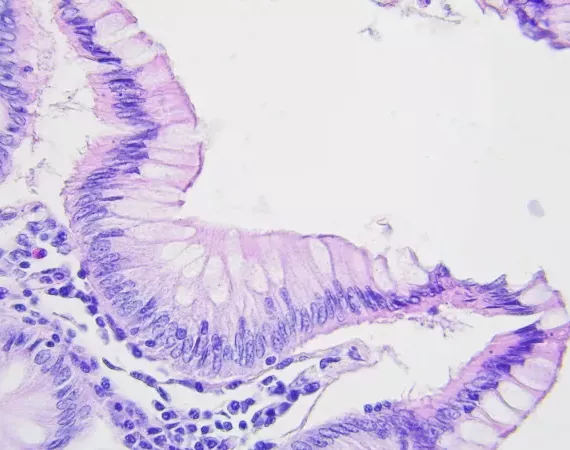 Mikroskopische Aufnahme von Dickdarmkrebs, Vergrößerung x400
