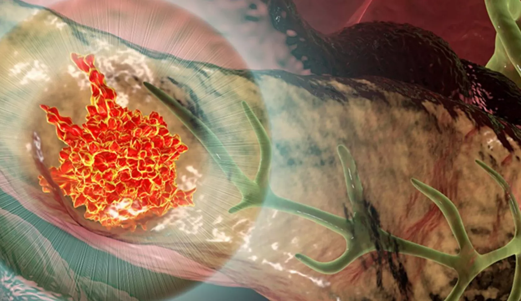 3D-Visualisierung von Pankreaskrebs / Karzinom der Bauchspeicheldrüse