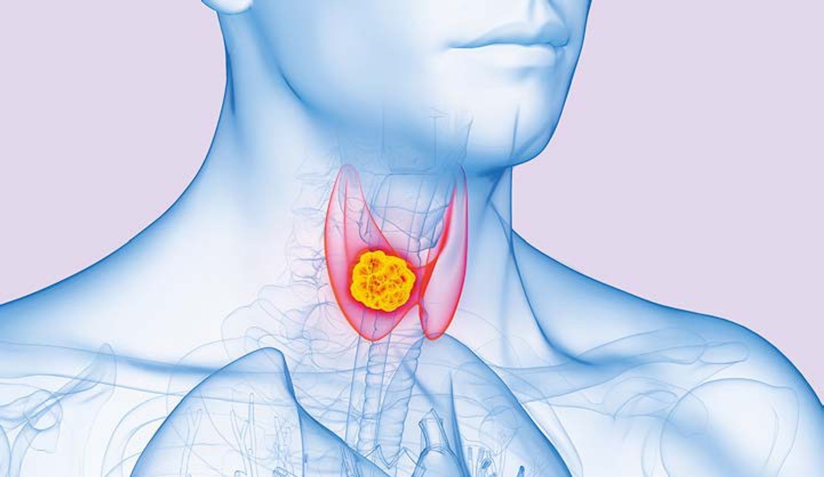 Ki-generierte Abbildung eines Halses mit Schilddrüse und einem Tumor (PTC)  daran.