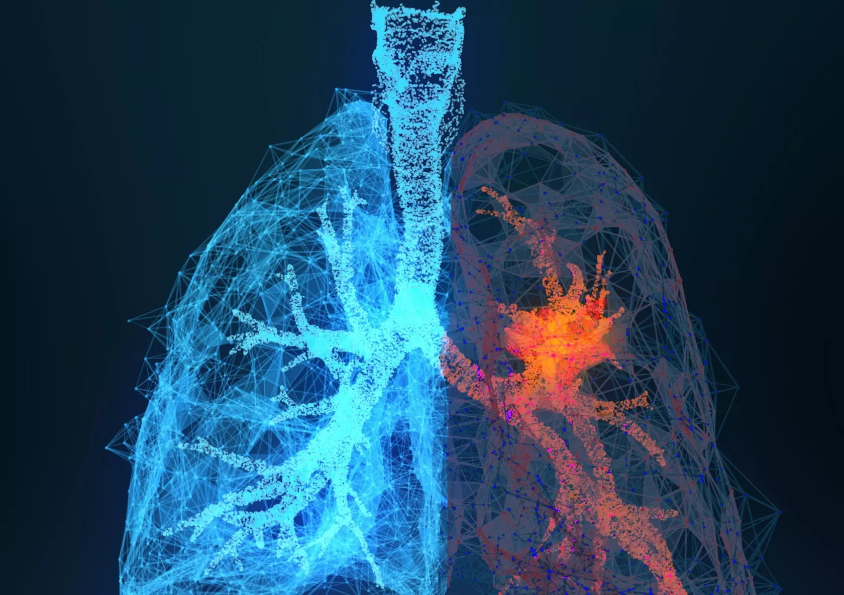 Lungenkrebs in einem Lungenflügel