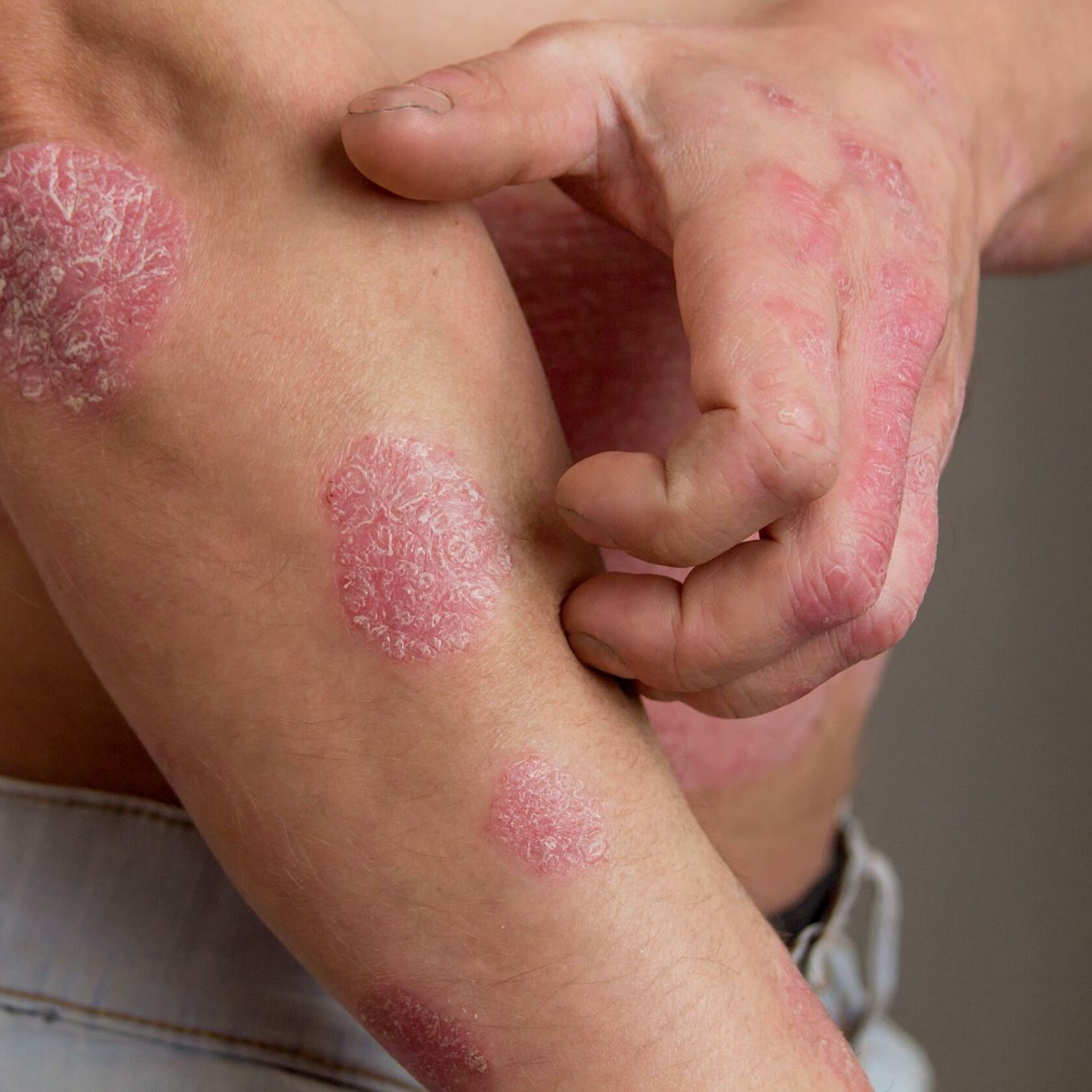 Psoriasis und atopische Dermatitis an Hand und Arm