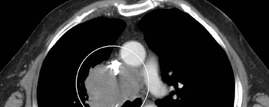 Ein Brust-CT (Beispielbild siehe unten) zeigte eine vollständige Obstruktion der SVC (superior vena cava) aufgrund einer Thrombose