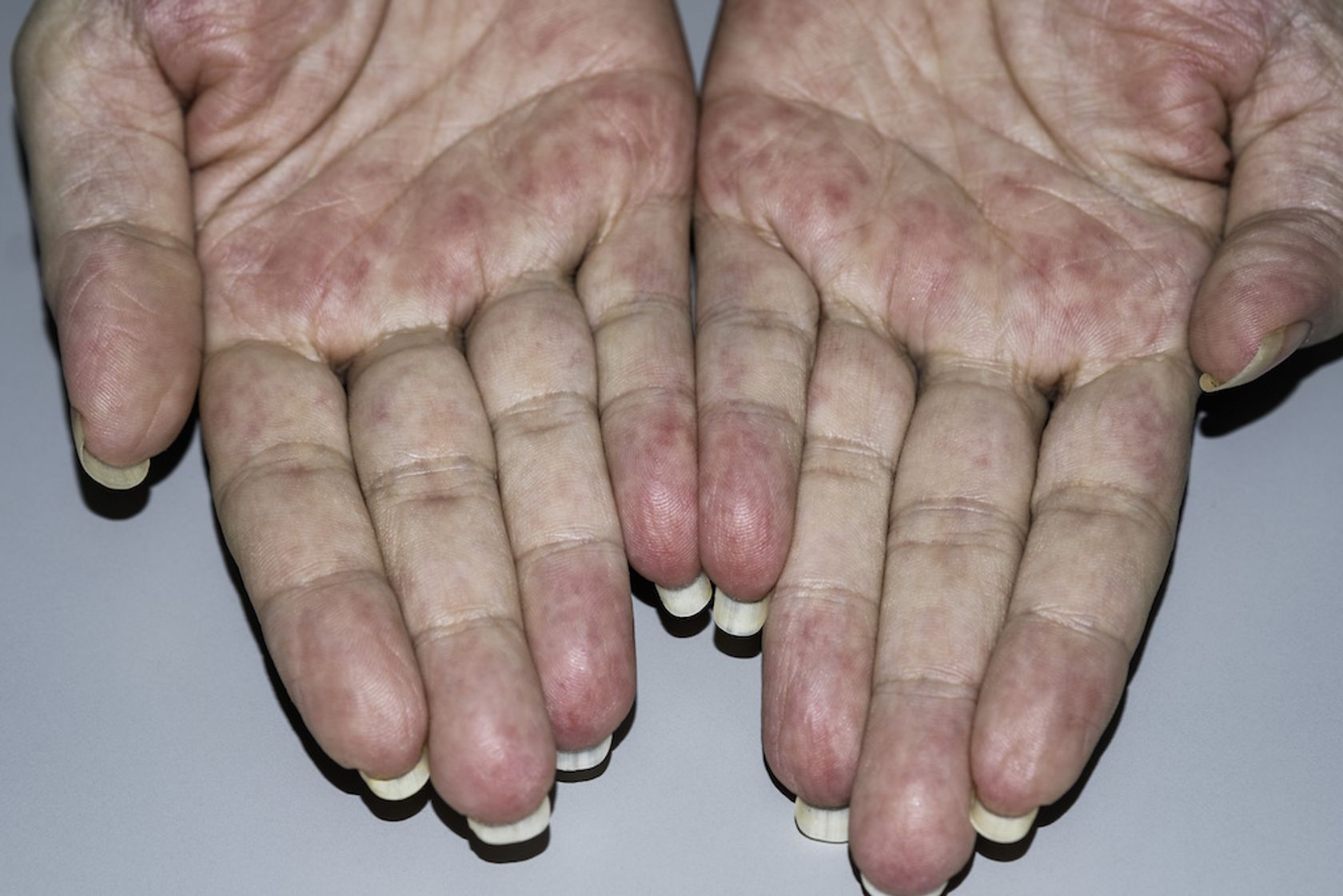 Vergiftung zeigt sich an unterschiedlicher Färbung der Hände und Finger
