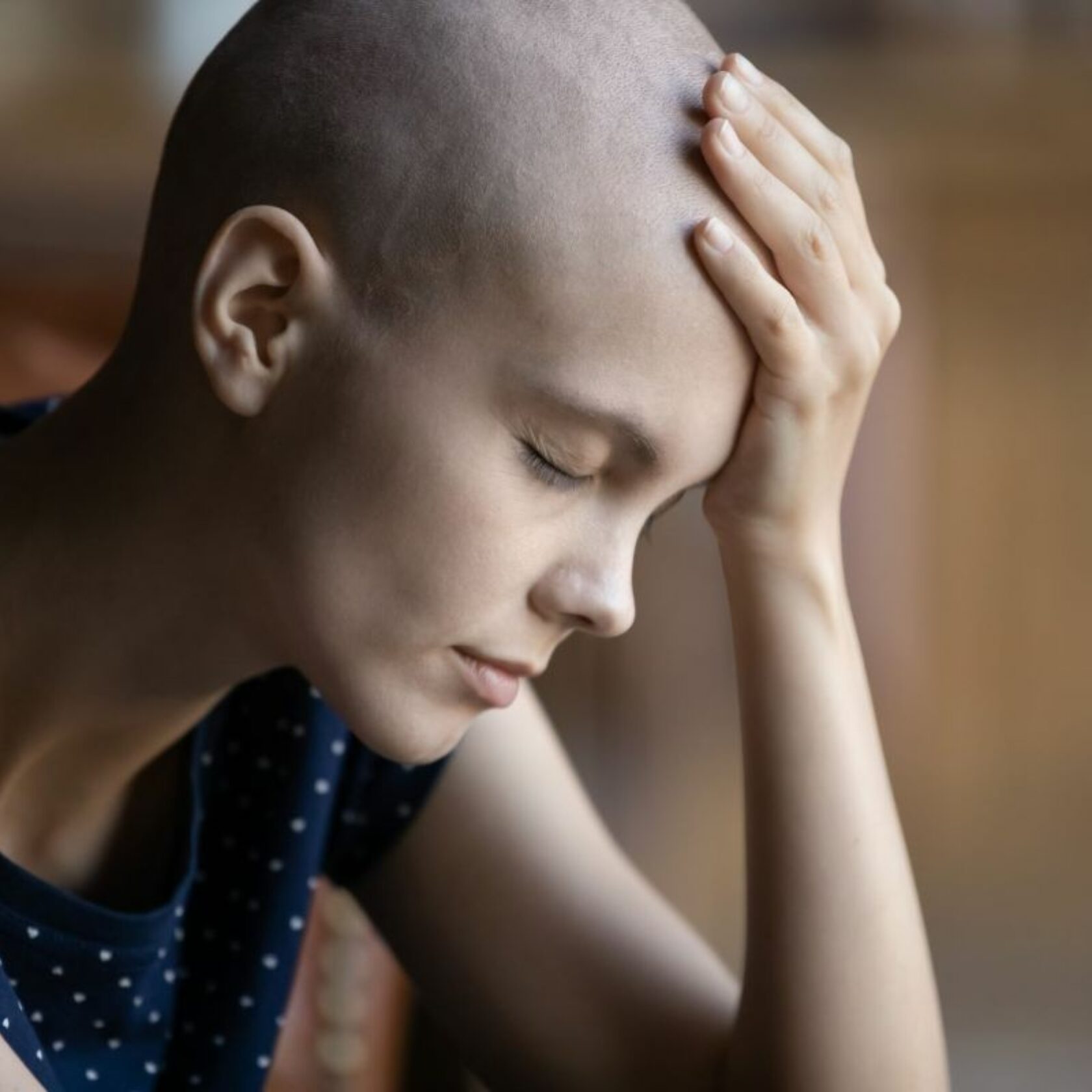 Haarlose Frau stützt den Kopf in die Hand. Sie leidet unter den Nebenwirkungen ihrer Chemotherapie