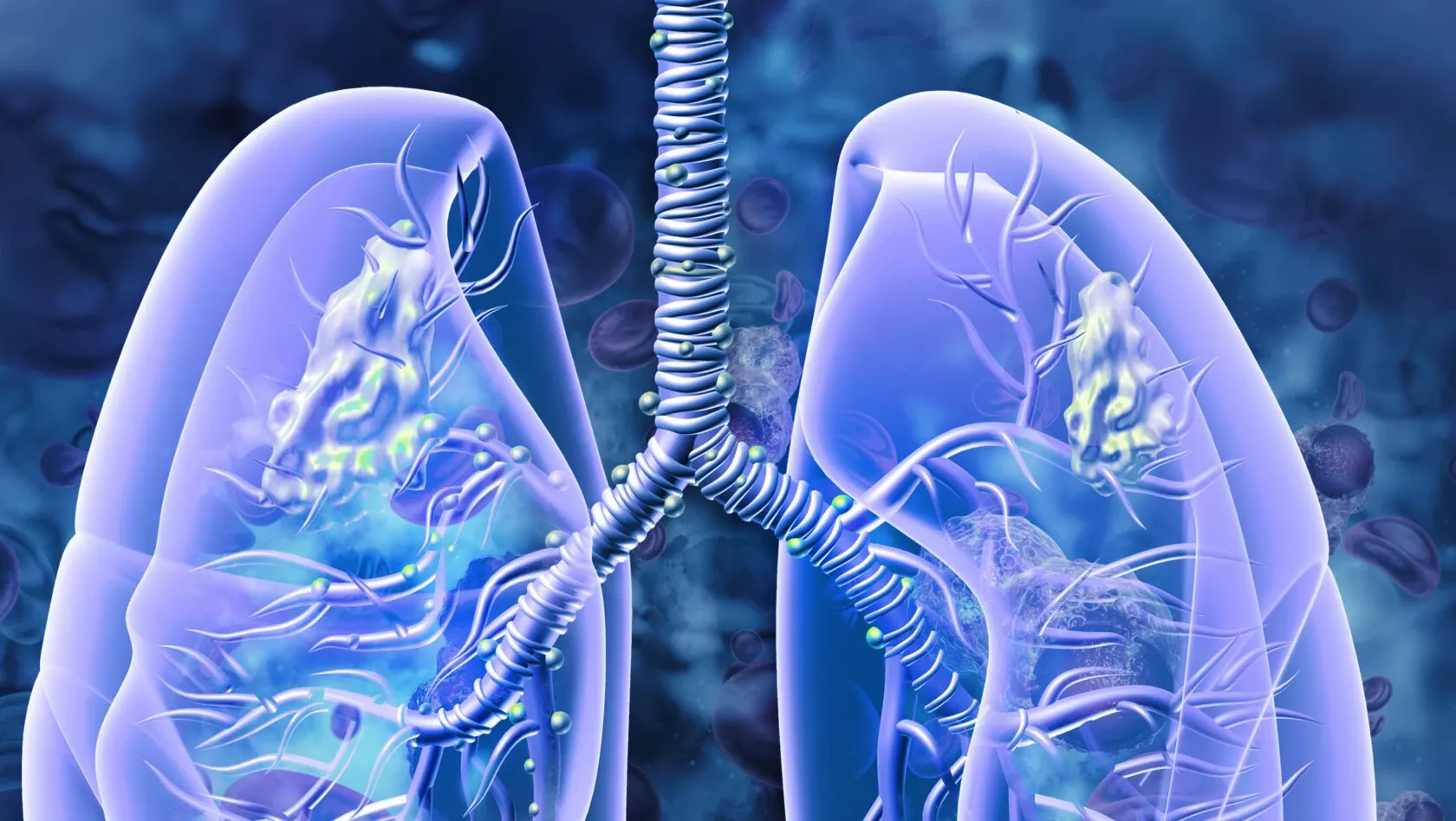 3D-Darstellung des kleinzelligen Lungenkarzinoms