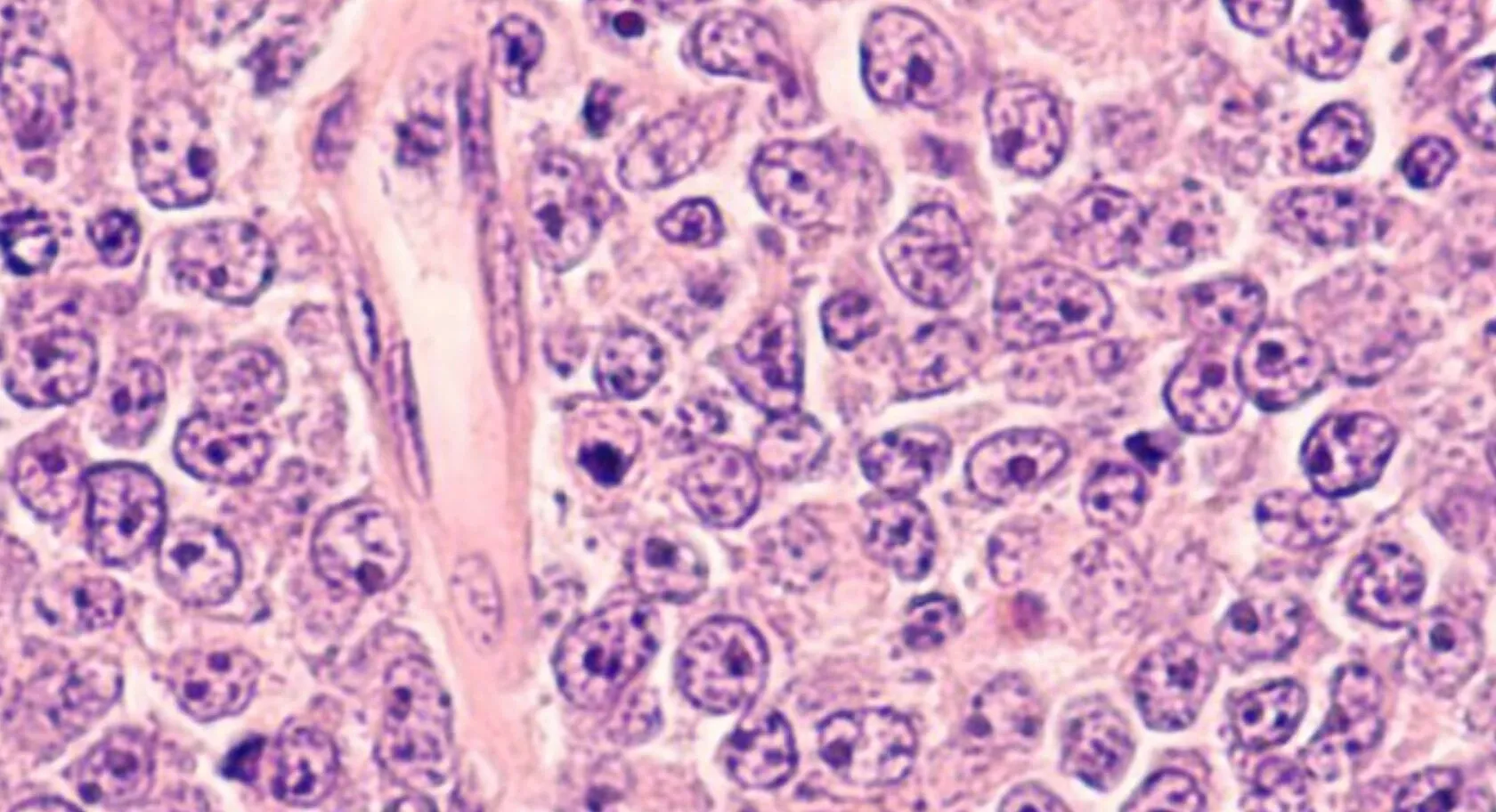 Diffuses großzelliges B-Zell-Lymphom im Querschnitt, Photomikrographie