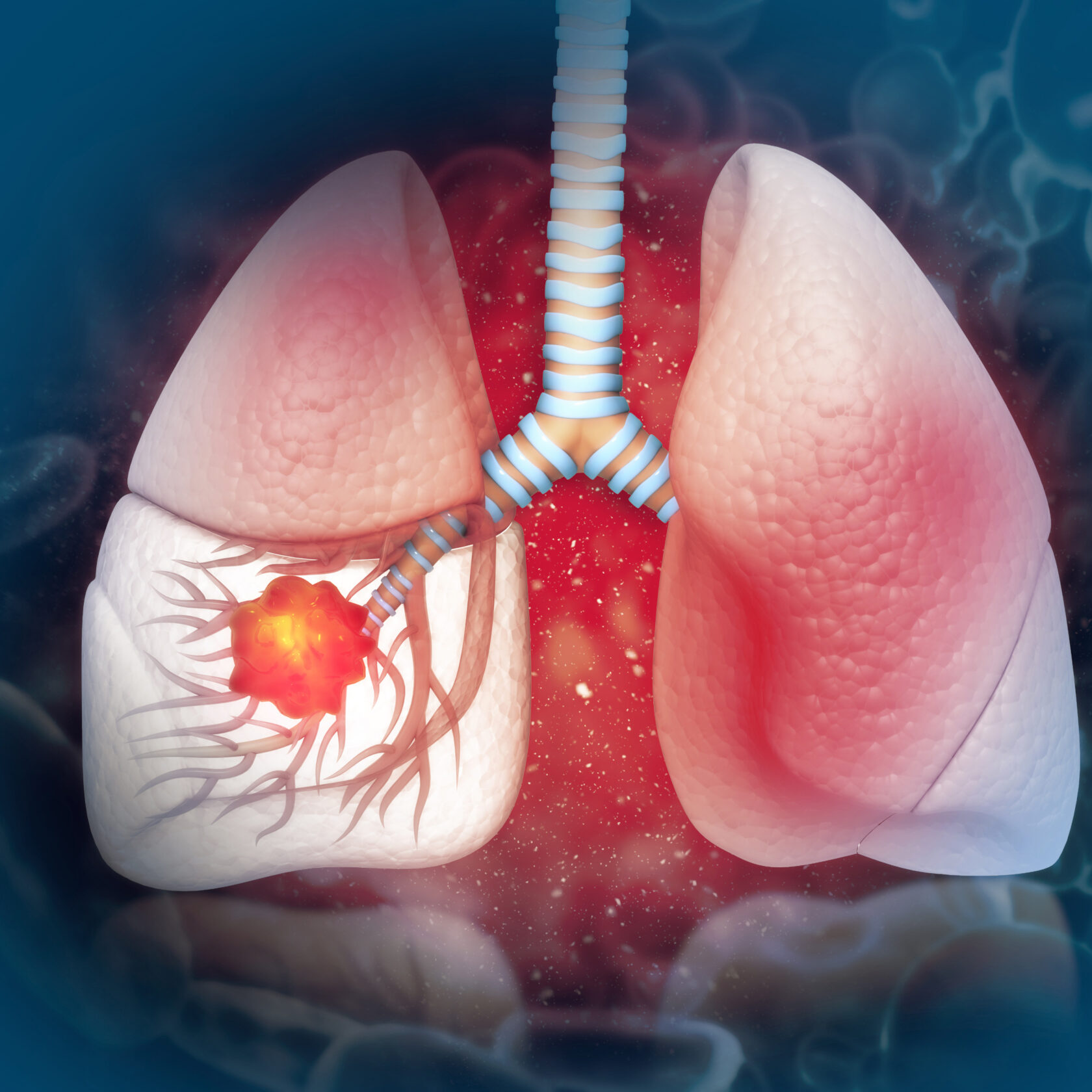 schematische Darstellung der Lunge mit einem Karzinom im rechten Lungenflügel
